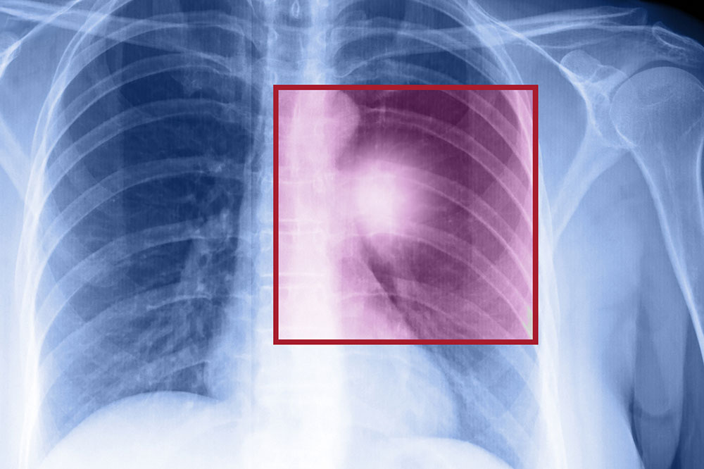 Lung cancer – Types, symptoms, and causes