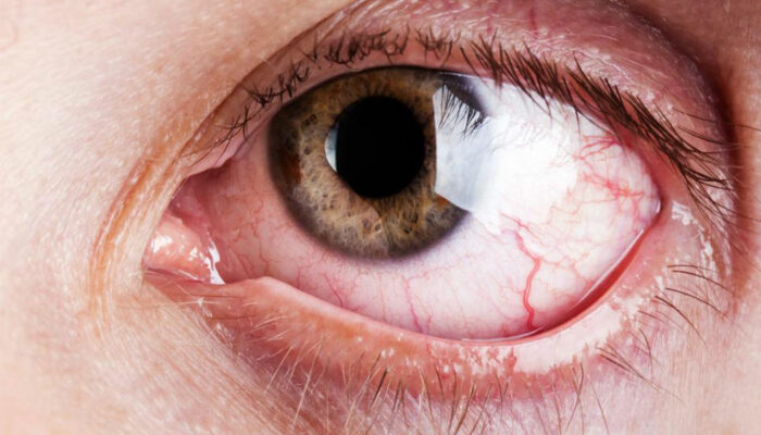 What are the common and rare symptoms of Graves’ disease