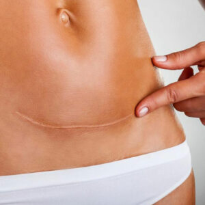 Beware of these 5 Early Ovarian Cancer Symptoms