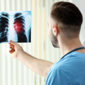 Lung Cancer – Risk Factors, Diagnosis, Symptoms, And Treatment