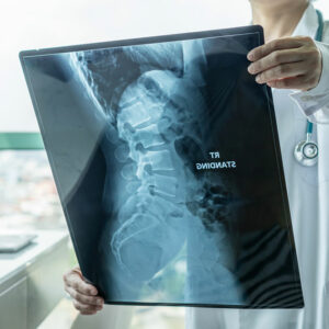 Spinal muscular atrophy – Types and symptoms